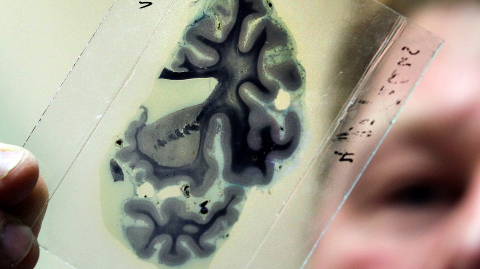 Niente 'farmaco anti-Alzheimer' da sanit&agrave; pubblica, polemica Gb