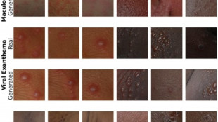 Malattie pelle, da UniBo Ai pi&ugrave; equa per diagnosi pi&ugrave; inclusiva