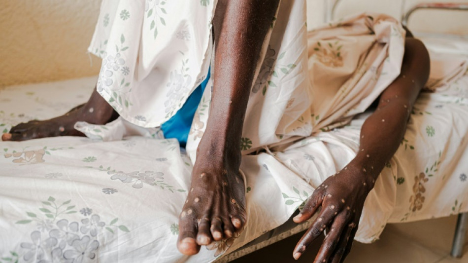 Comienza en Ruanda la primera campa&ntilde;a de vacunaci&oacute;n contra la mpox en &Aacute;frica