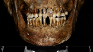 La dentition d'une aristocrate du XVIIe si&egrave;cle comme marqueur social