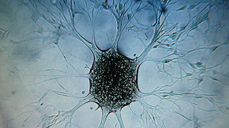 Una nuova terapia con anticorpi per rallentare il glioblastoma