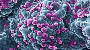 Tumori, nuovo paradigma di cure con l'immunoterapia neoadiuvante